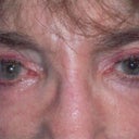 Dr. Levine’s Before Office Photo. Before surgery, pupil size the same.