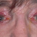 Dr. Levine’s After Office Photo. Following surgery, another eye specialist noted my left pupil was enlarged and didn’t dilate. This indicates a potentially serious and irreversible complication.