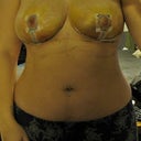 Day 6 - Post Op
A better picture to show the scale of the new size to my body.  Bruised every colour of the rainbow.