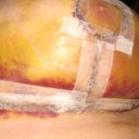Day 6 - Post Op
Closer shot of the right side - dark red/purple colour I was talking about above and below the bottom incision.  Not sure if it's just bruising or something else.
