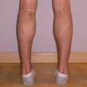 This Is A 28 Y.o. Man Wanted Calf Implants.  
