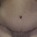 Close up or scar & bellybutton, new stretch marks....and a dogear on my right. Doc said he'd fix it at 6 months if it's still there.