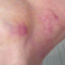 4 days after procedure