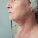 4 days after procedure