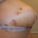 Post op day 9