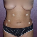 Front View 2.08.13 (36 hours after surgery)