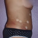 Right Side View 2.08.13 (36 hours after surgery)