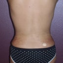 Back View 2.08.13 (36 hours after surgery)