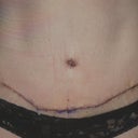 7 days scars. still so bloody looking because the incision is covered by glue and i cannot wash off the scabs and blood crusts