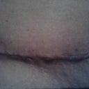 The Redness at the incision when will that go down and the "Puckering" look I see.
