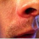 Large indentation in nostril created. Still prominent after a month