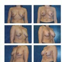 These are my "befores" of my first surgery to get the implants back in 06.