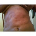 Pictures taken at home showing true 
results of revision lipo