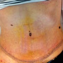 Post-op Day 6 (super low scar, just above pubic area)