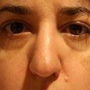 eyes post filler, believe it or not