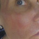Day 1 - Post Fraxel