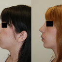 One year post-op -- profile view