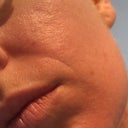 2 weeks after 2nd treatment left cheek