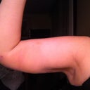 2 weeks post op