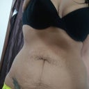 3/20/2012-2 months prior to my surgery at 126.6lbs