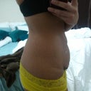 3/20/2012-2 months prior to my surgery at 126.6lbs