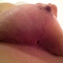 Day 14 right breast where hematoma was, now  small opening.