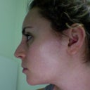 Left side 3 weeks post-op