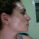 Right side 3 weeks post-op