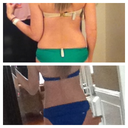 before and after liposonix