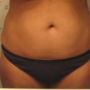 Before: The night before surgery