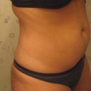 Before: Side 