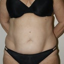 Pre-Tummy Tuck