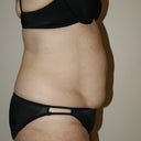 Pre-Tummy Tuck