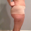 Side - 2 weeks post op-  like this view!