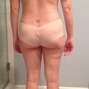 back 2 weeks post op (slight angle)