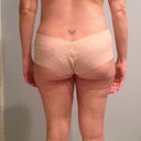 back 2 weeks post op - butt and arms needs a lot of work! still think it could be slimmer