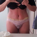 Day 1 PO This pair of underwear comes up a little higher than the ones I wore to be marked in, but the incision is a little lower than this pair of undies, so I think he totally got the scar right on!