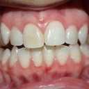 Before treatment