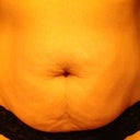 Pre Surgery pic 3 July 2012
