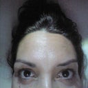 After 2 wks. No makeup and my big vertical line between eyebrows bye bye