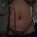 1 day post op