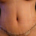 10days post op, love the BB