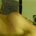post op day 31, side. The scar is actually redder than it looks here. I'm trying shea butter at PNW's recommendation.