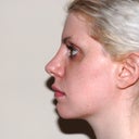 1 year 1 month post-op, 12 days after in-office procedure.  There is still a lot of swelling around the bridge and tip.  The tip swelled a lot following the procedure.