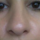 5 months post op...swelling still present