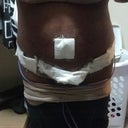 Day 4 - Post Op