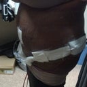 Day 4 Post Op