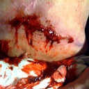 Typical response from my incision when I try to do normal daily movements.. Stretching, trying to bend etc.. 02/24/11