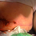 As you can see it randomly opens and bleeds rather quickly altho I do not take any blood thinners at all.