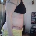 2 weeks post surgery